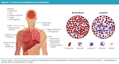 Chronic Myelogenous Leukemia