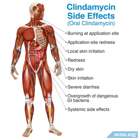 Clindamycin Vs Erythromycin Topical For Acne at Roy Wall blog