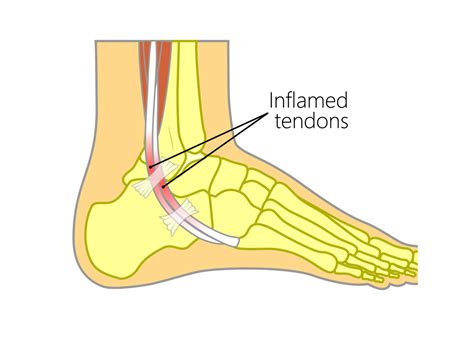 Peroneal Tendonitis - Upswing Health | Upswing Health