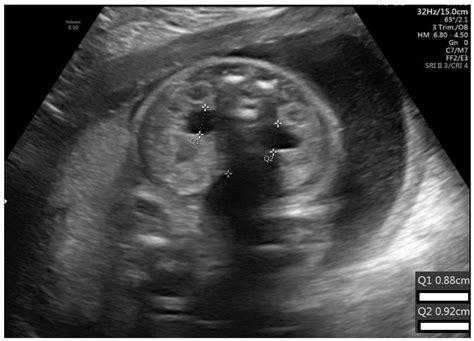 Fetal Hydronephrosis Ultrasound