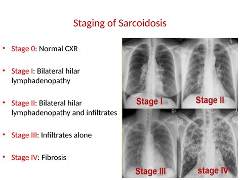 Sarcoidosis Respiratory Disease Slide Note | PPTX