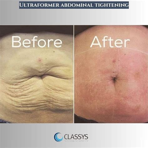 Ultraformer III treatment before & after photos