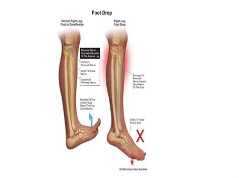 Presentationcommon%20peroneal%20nerve%20injury.pptx