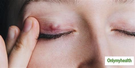 What Makes Eyelid Swell? Know The 5 Major Causes Of Eyelid Inflammation ...