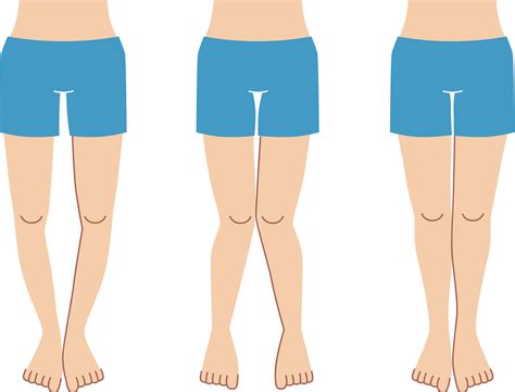 Intoeing - Comfort Feet Podiatry Group