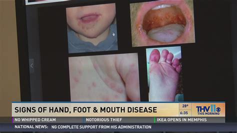 Hand Foot And Mouth Disease Baby