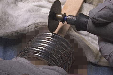 Man passes out with 9 rings 'strangling' penis, scrotum: surgeons