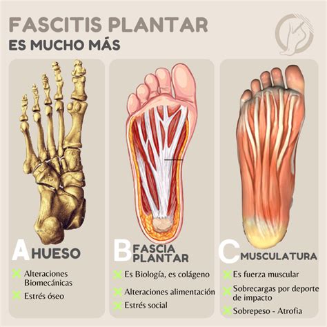 Anatomía De La Fascitis Plantar Ultimate Guide To Tackling Plantar