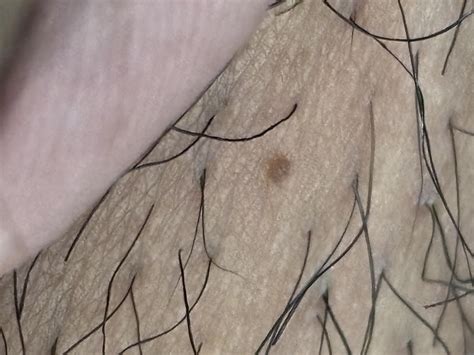 Skin tag or genital warts? : r/DermatologyQuestions