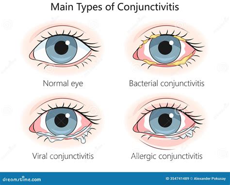 Main Types Conjunctivitis Diagram Medical Science Stock Illustration ...
