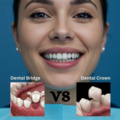 Dental Crowns And Bridges
