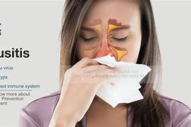 Image result for sinusitis