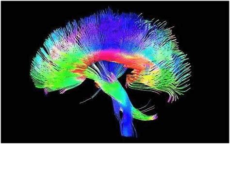 Image result for Diffuse Tensor Imaging