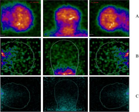 A scintigraphic look at the dead donor rule in donation after the ...