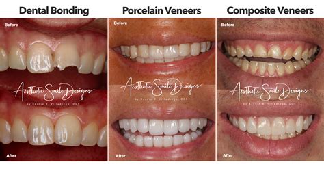 Composite Veneers Pros And Cons