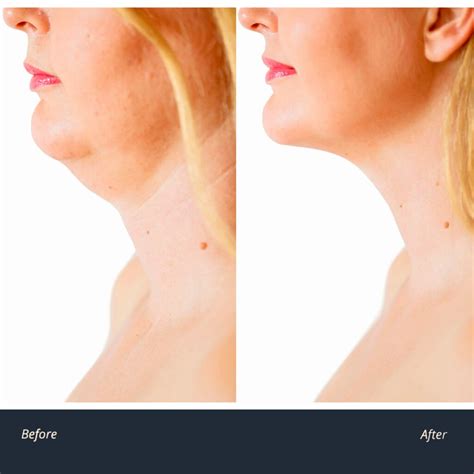 Turkey Neck Treatment