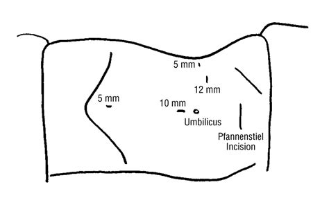 Image result for Hand-Assisted Nephrectomy