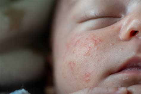 Red Rash On Baby Face And Chin at Alan Matheny blog