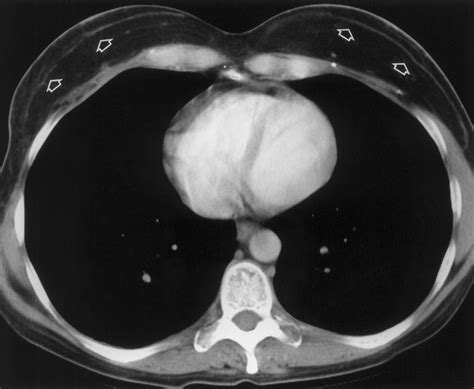 Breast Reconstruction with TRAM Flaps: Normal and Abnormal Appearances at CT | RadioGraphics