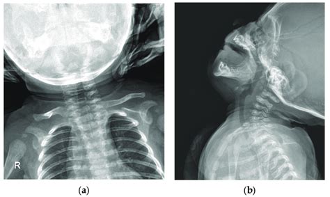 Image result for Contralateral View