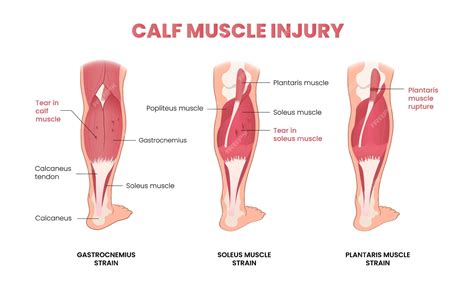 Premium Vector | Calf muscle injury infographic
