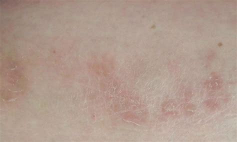 Rare case of Systemic sarcoidosis presenting as combination of ...