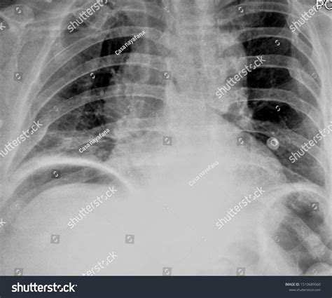 Gas Pain Diaphragm at Ronald Eccles blog