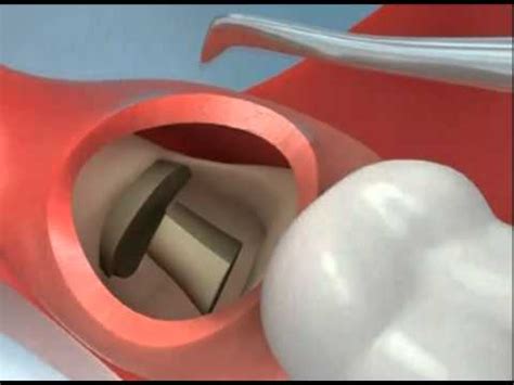 Wisdom Teeth Extraction Video Lecture - Dental