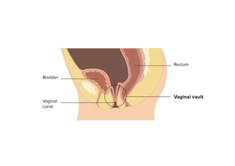 Vaginal Vault Prolapse