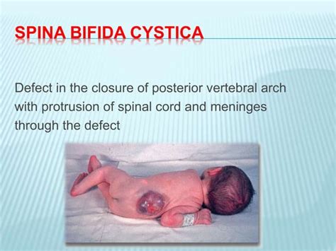 Image result for Neural Tube Defects Causes