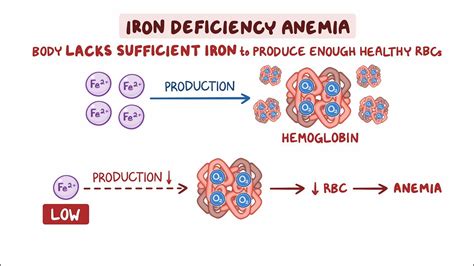 Video: Iron deficiency anemia: Clinical sciences | Osmosis