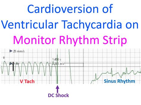 Image result for Synchronized Cardioversion Rhythm Strip
