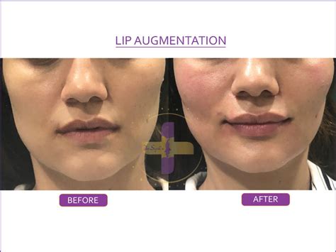 Lip Augmentation in Saket, South Delhi & Gurgaon | Royal Lush Clinic