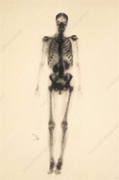 Image result for Normal Bone Scan