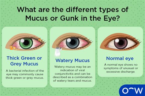Types Of Eye Mucus, Discharge, And Boogers, 55% OFF