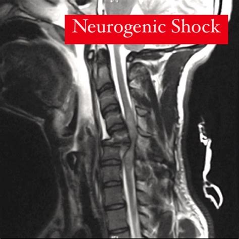 Mahmoud Moustafa on LinkedIn: NEUROGENIC SHOCK: form of distributive shock (tank size problem);…