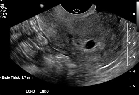 Molar Pregnancy - Radshare