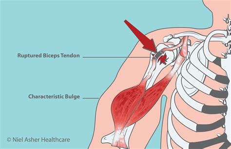 Biceps injuries: what to do and where? – biceps tendonitis symptoms | XAKY