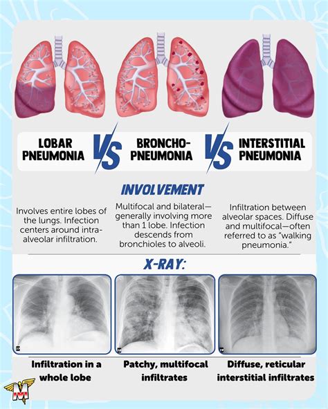 Study with MedSchoolBro | Lobar vs Broncho- vs Interstitial Pneumonia ...