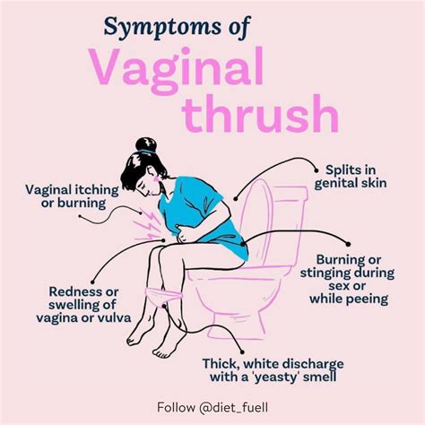 Vaginal Discharge Thrush