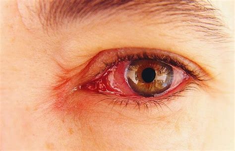Faktor Resiko Penyebab Mata Merah yg Tiba-tiba dan Mengobati Mata Merah ...