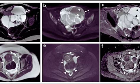 DWI-MRI helpful for pre-operative evaluation of patients with ovarian ...