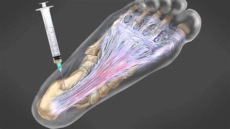 Steroid Injection Plantar Fasciitis Cost Uk at Rebecca Bowens blog