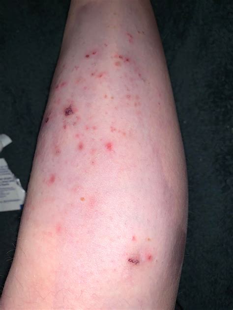 I did the scabies ink test-is this what a positive result is? Helpp i ...