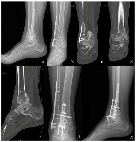 X Ray Hindfoot Fusion
