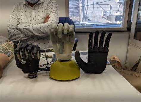 After Losing Hand to Delhi Riots, Akram Khan to Finally Get Robotic ...