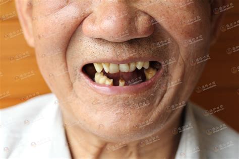 镶牙的种类及价格——广州德伦口腔