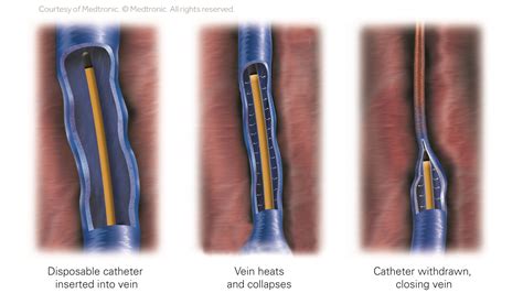 Varicose Vein Ablation | The Vein Institute of Blue Bell
