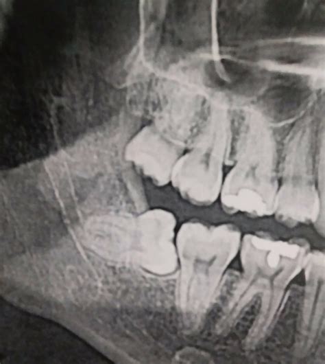 My wisdom tooth growing in completely sideways. : r/mildlyinteresting