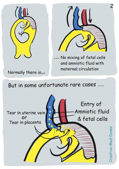 Amniotic Fluid Embolism - Creative Med Doses